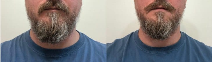 Beard Oil Before and After Photos - Short Beard